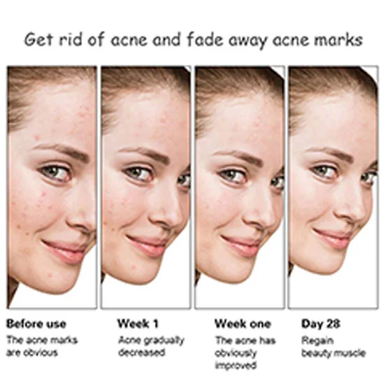 Aichun beauty Anti Acne Whitening Facial Serum 30 ML - Image 4